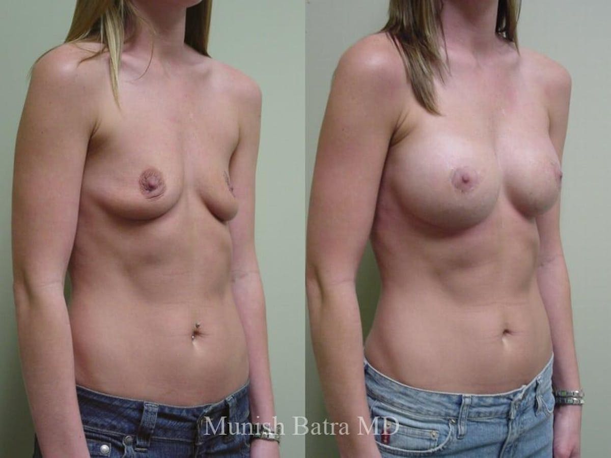 Breast Augmentation Before & After Gallery - Patient 275903 - Image 2