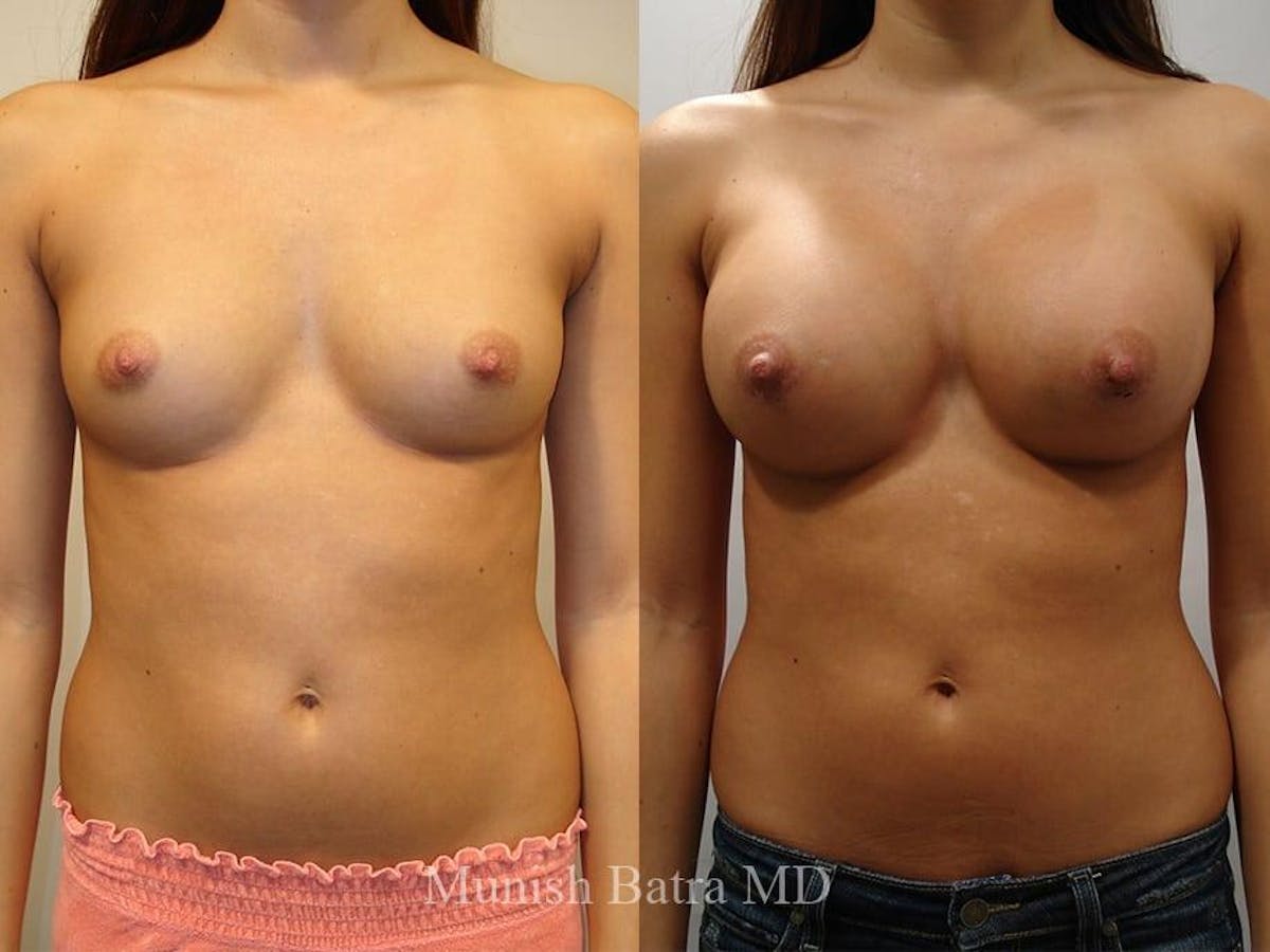 Breast Augmentation Before & After Gallery - Patient 936445 - Image 1