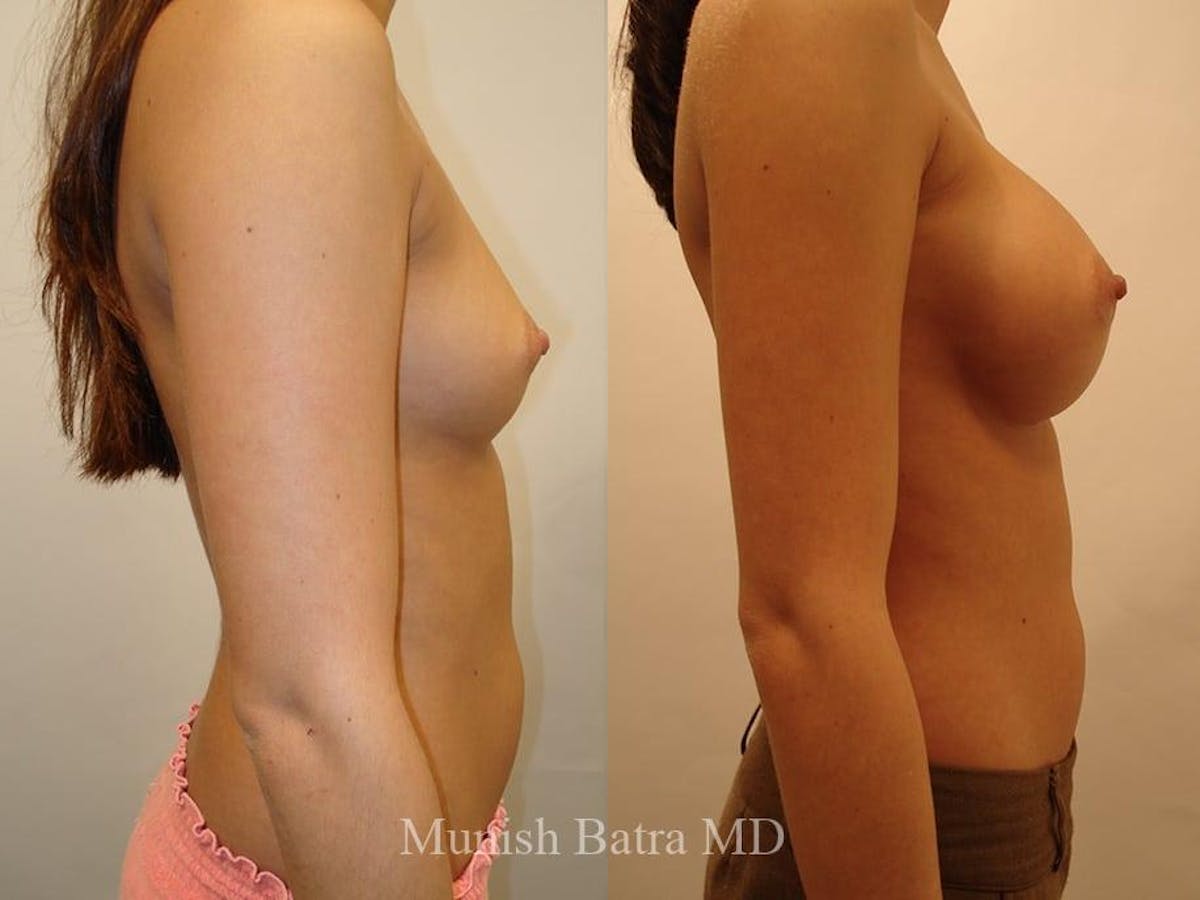 Breast Augmentation Before & After Gallery - Patient 936445 - Image 2