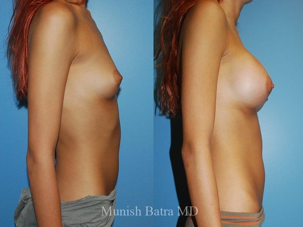 Breast Augmentation Before & After Gallery - Patient 143819 - Image 2