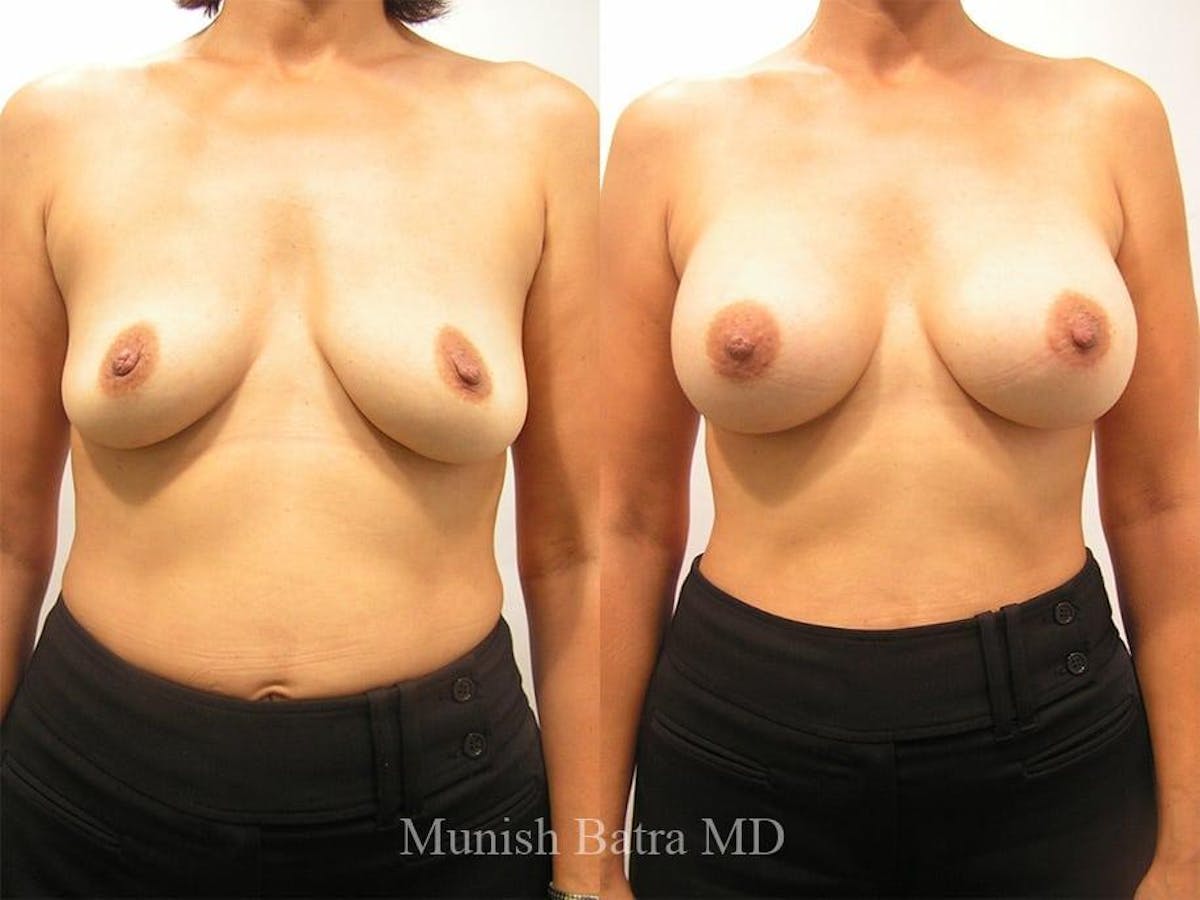 Breast Augmentation Before & After Gallery - Patient 340378 - Image 1