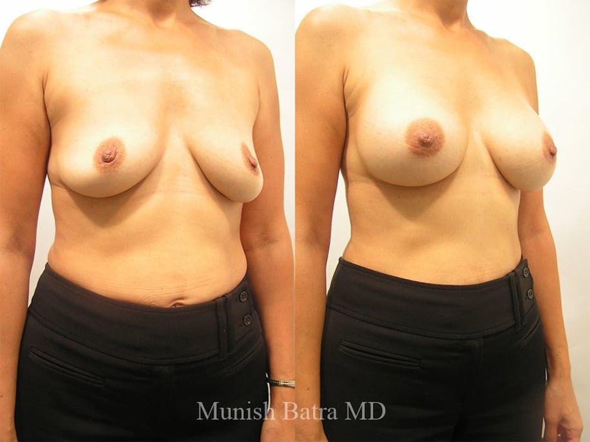 Breast Augmentation Before & After Gallery - Patient 340378 - Image 2