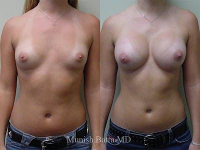 Breast Augmentation Before & After Gallery - Patient 290864 - Image 1