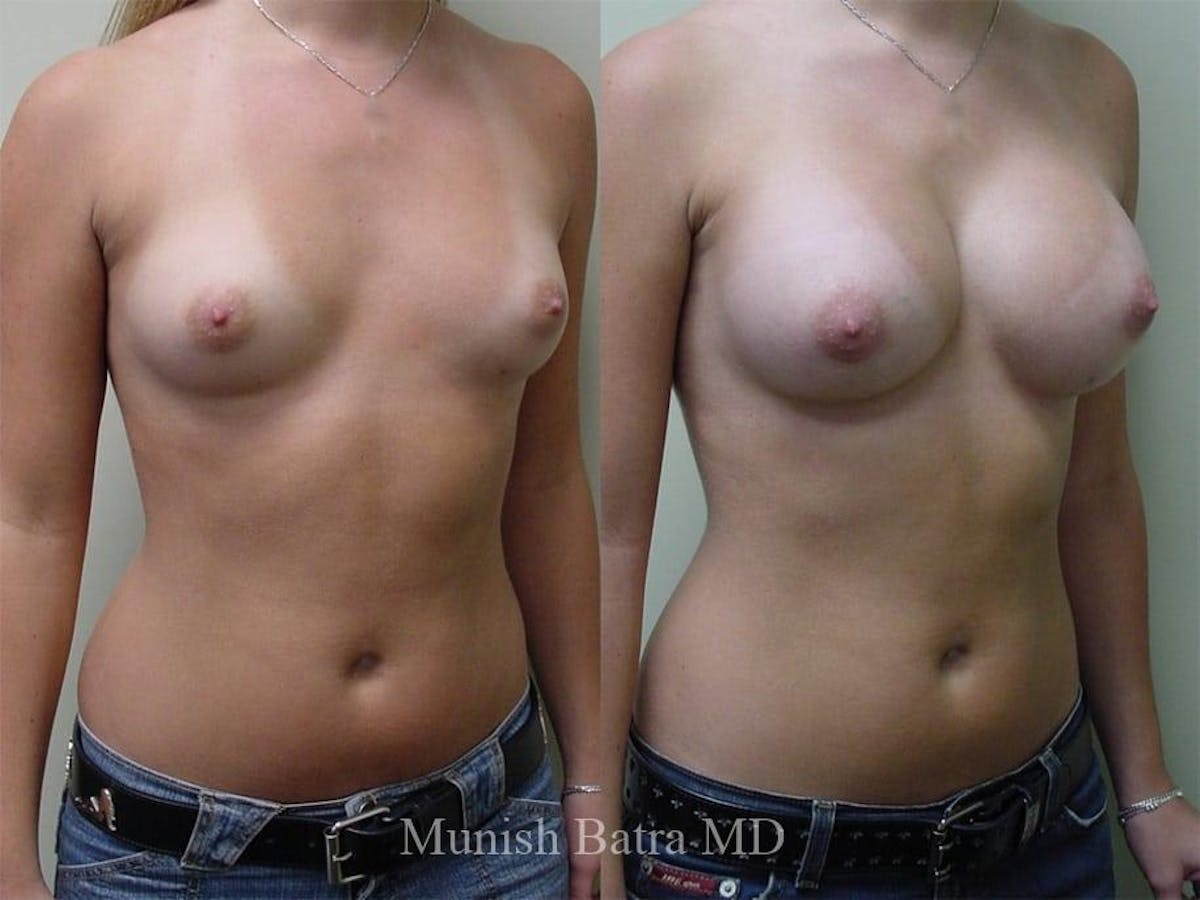 Breast Augmentation Before & After Gallery - Patient 290864 - Image 2