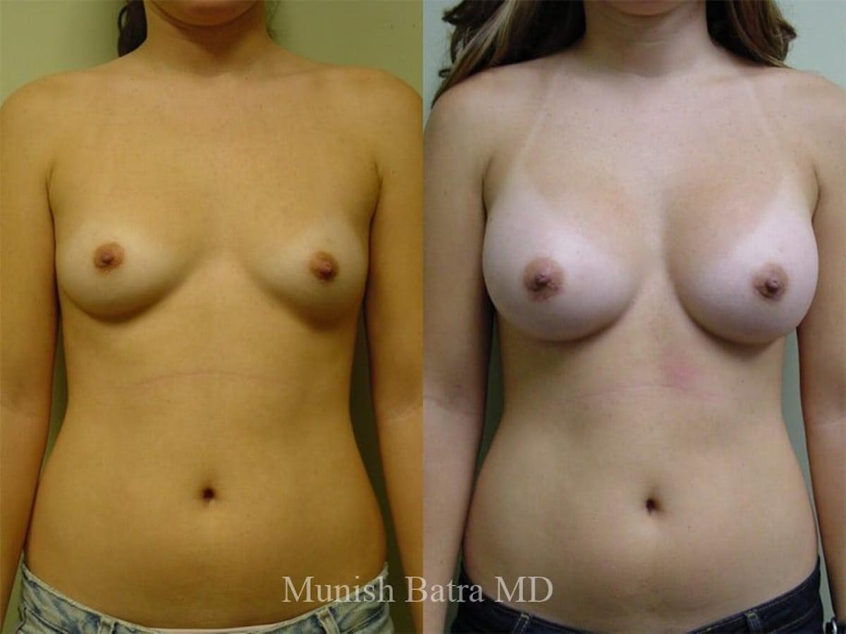 Breast Augmentation Before & After Gallery - Patient 193763 - Image 1