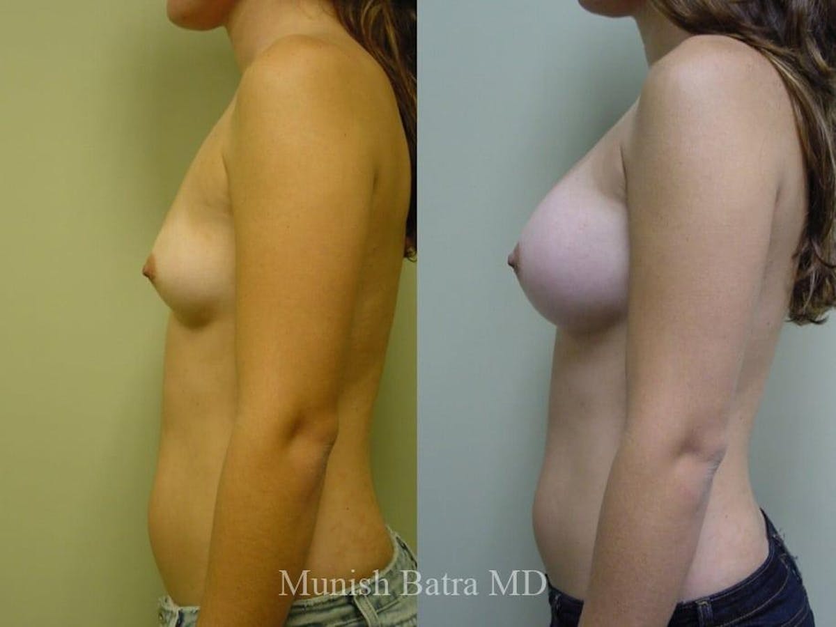 Breast Augmentation Before & After Gallery - Patient 193763 - Image 2