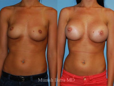 Breast Augmentation Before & After Gallery - Patient 822298 - Image 1