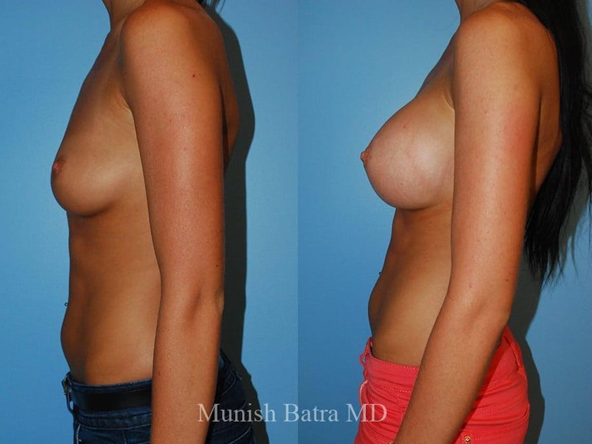 Breast Augmentation Before & After Gallery - Patient 822298 - Image 2