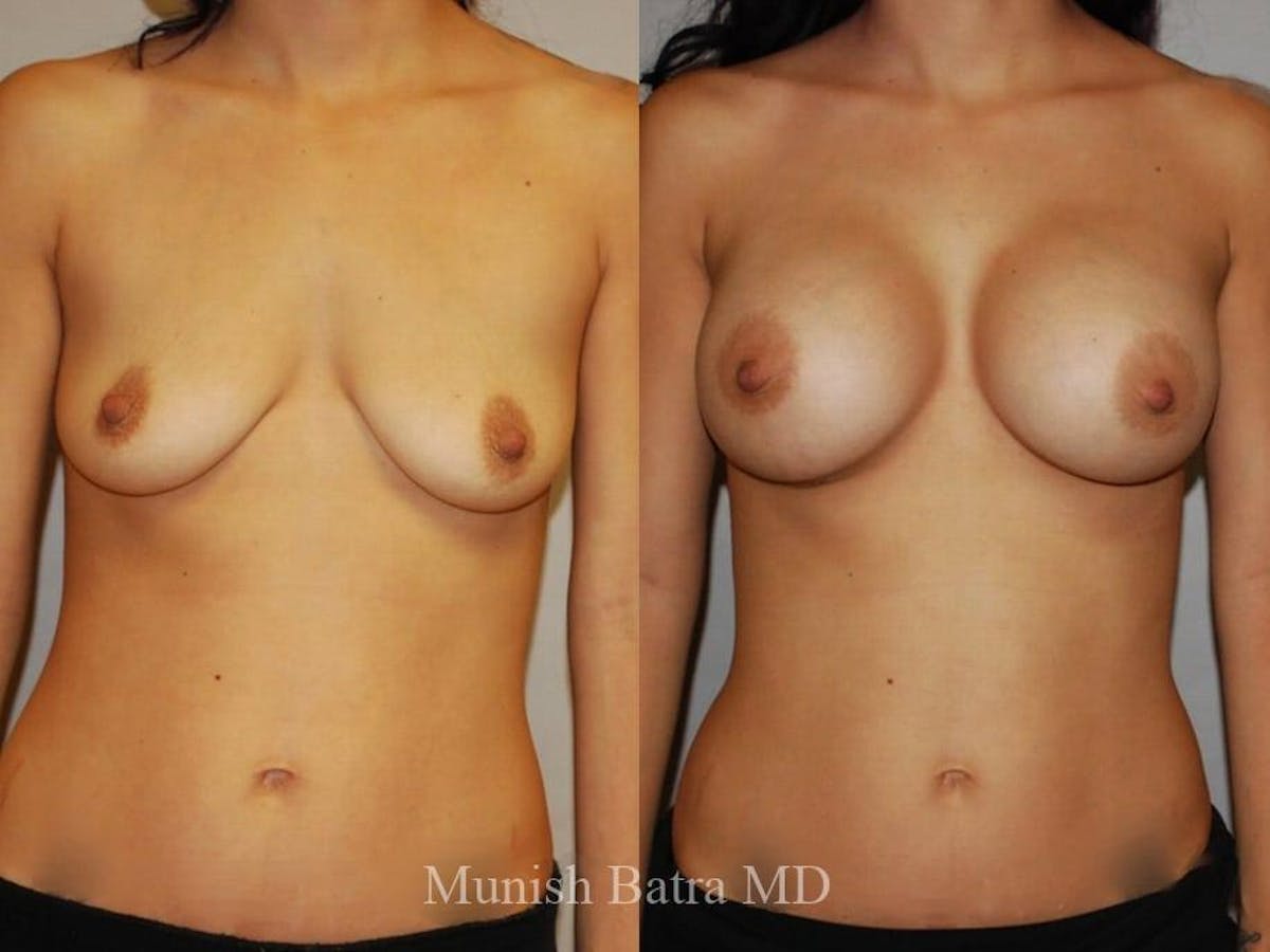 Breast Augmentation Before & After Gallery - Patient 194511 - Image 1
