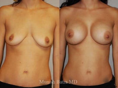 Breast Augmentation Before & After Gallery - Patient 194511 - Image 1