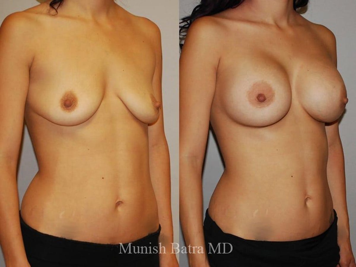 Breast Augmentation Before & After Gallery - Patient 194511 - Image 2