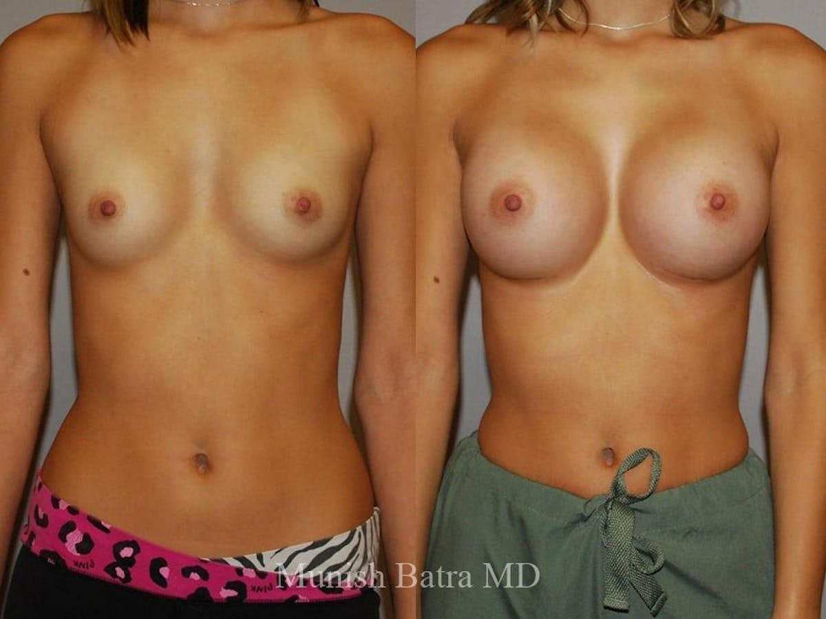Breast Augmentation Before & After Gallery - Patient 159416 - Image 1