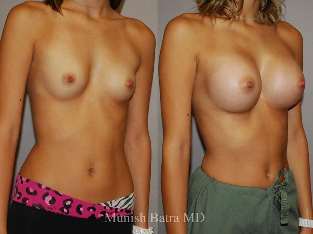 Breast Augmentation Before & After Gallery - Patient 159416 - Image 2