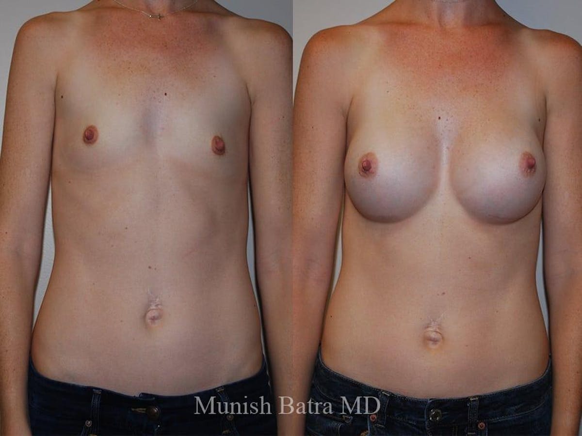 Breast Augmentation Before & After Gallery - Patient 185601 - Image 1