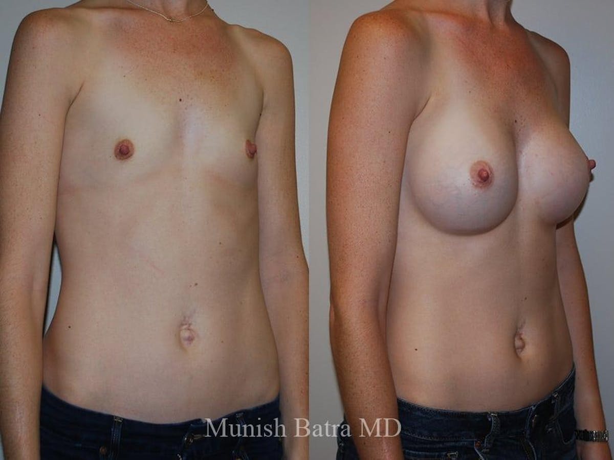 Breast Augmentation Before & After Gallery - Patient 185601 - Image 2