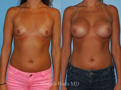 Breast Augmentation Before & After Gallery - Patient 415335 - Image 1