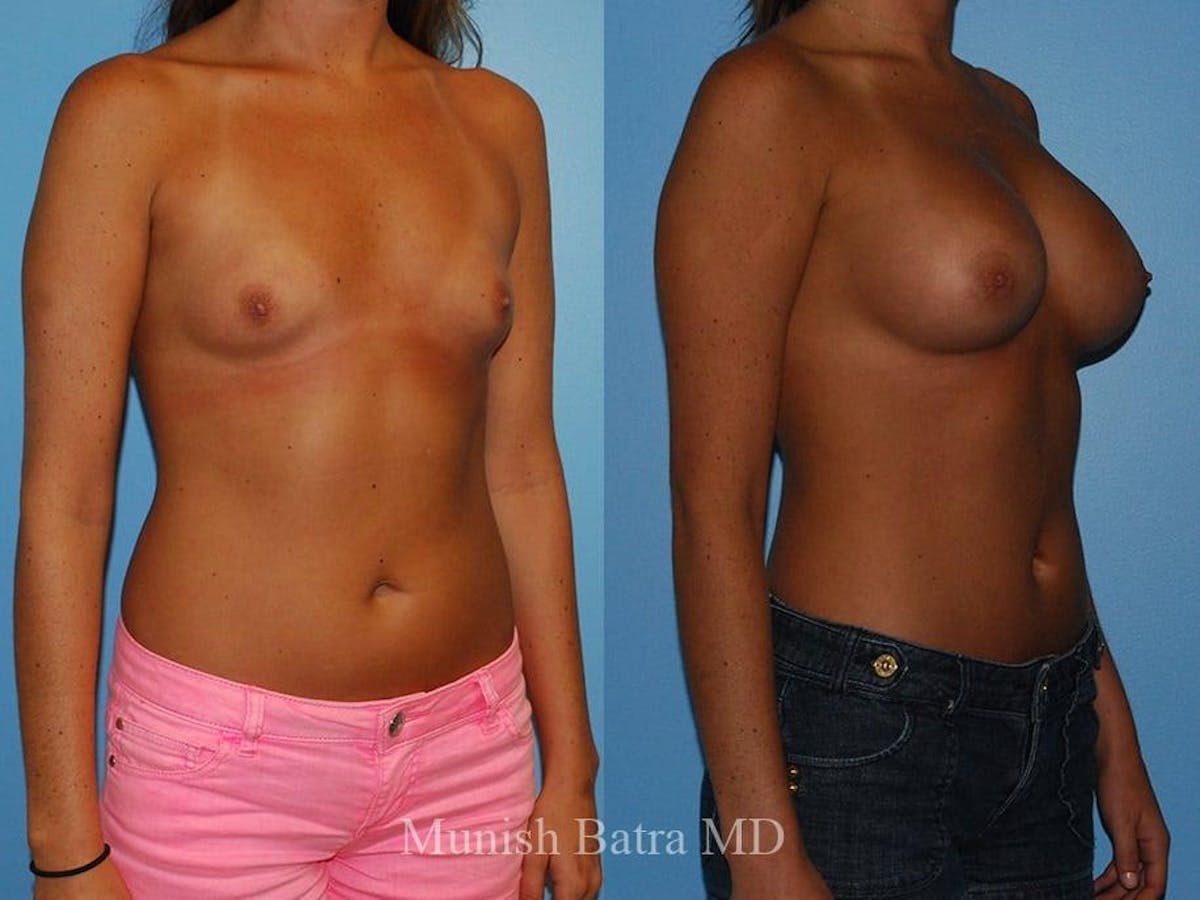 Breast Augmentation Before & After Gallery - Patient 415335 - Image 2