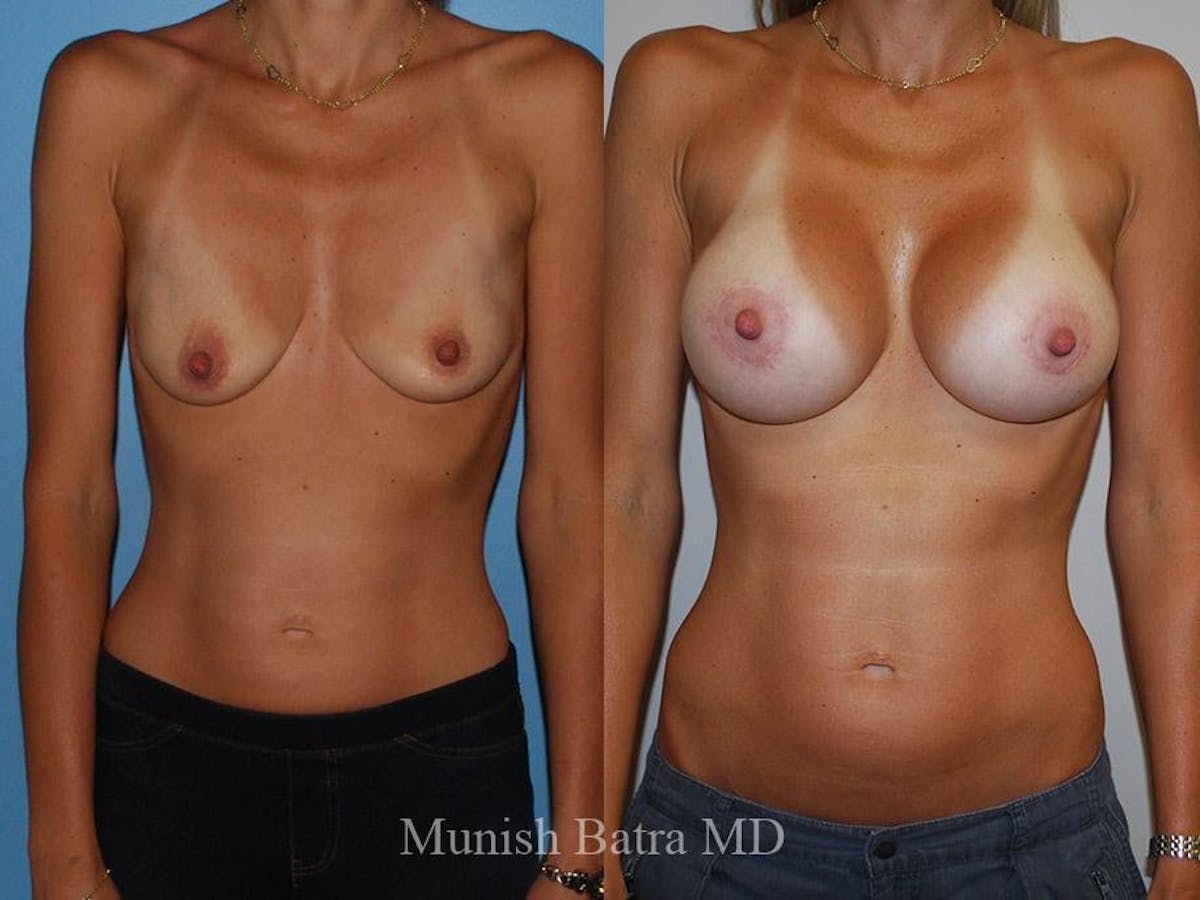 Breast Augmentation Before & After Gallery - Patient 182466 - Image 1