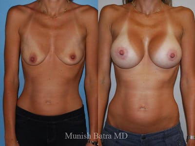 Breast Augmentation Before & After Gallery - Patient 182466 - Image 1