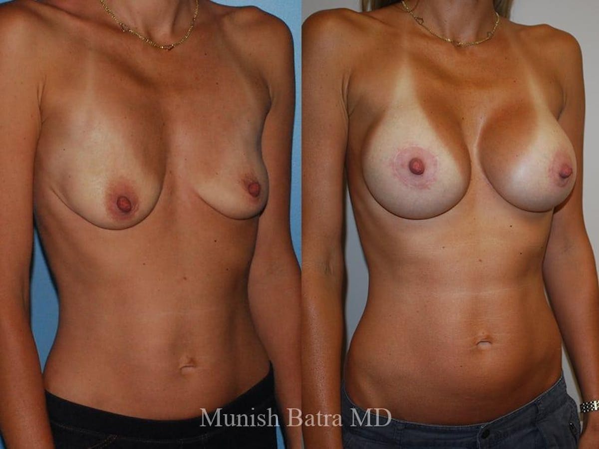 Breast Augmentation Before & After Gallery - Patient 182466 - Image 2