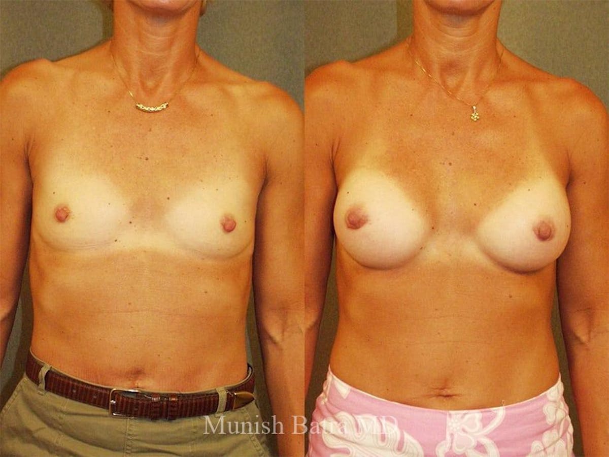 Breast Augmentation Before & After Gallery - Patient 258237 - Image 1