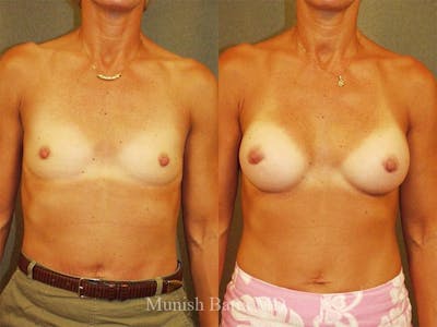 Breast Augmentation Before & After Gallery - Patient 258237 - Image 1
