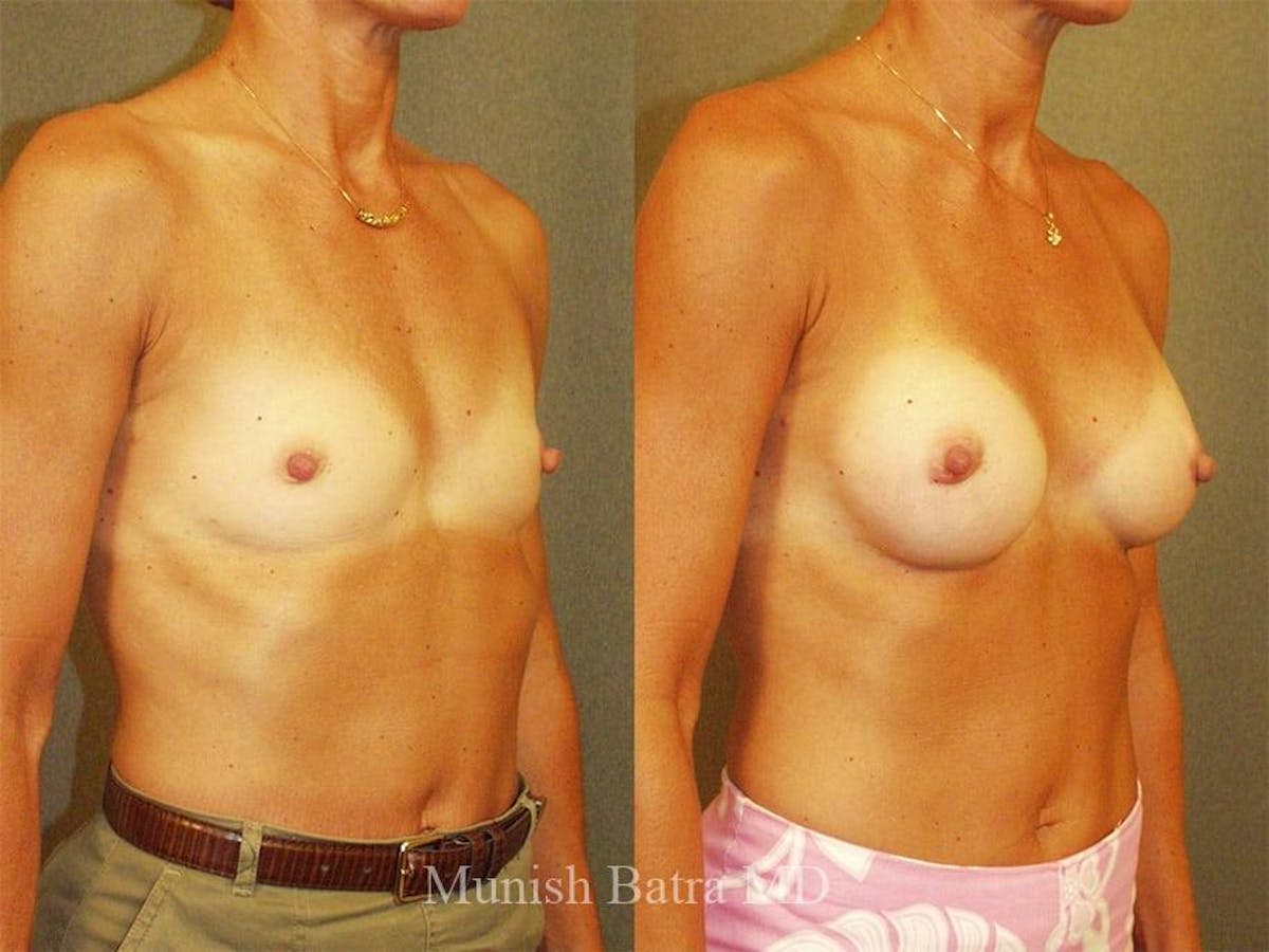 Breast Augmentation Before & After Gallery - Patient 258237 - Image 2