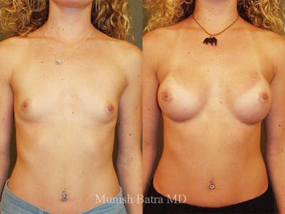 Breast Augmentation Before & After Gallery - Patient 411718 - Image 1