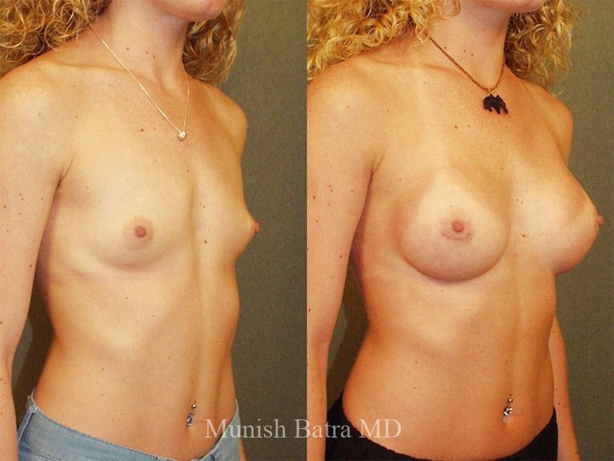 Breast Augmentation Before & After Gallery - Patient 411718 - Image 2