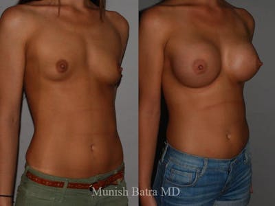 Breast Augmentation Before & After Gallery - Patient 202833 - Image 1