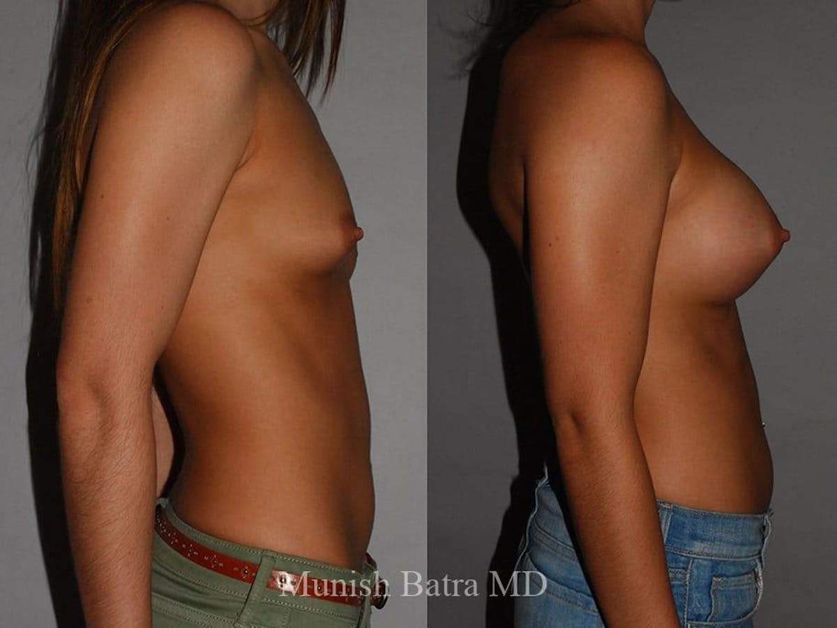Breast Augmentation Before & After Gallery - Patient 202833 - Image 2