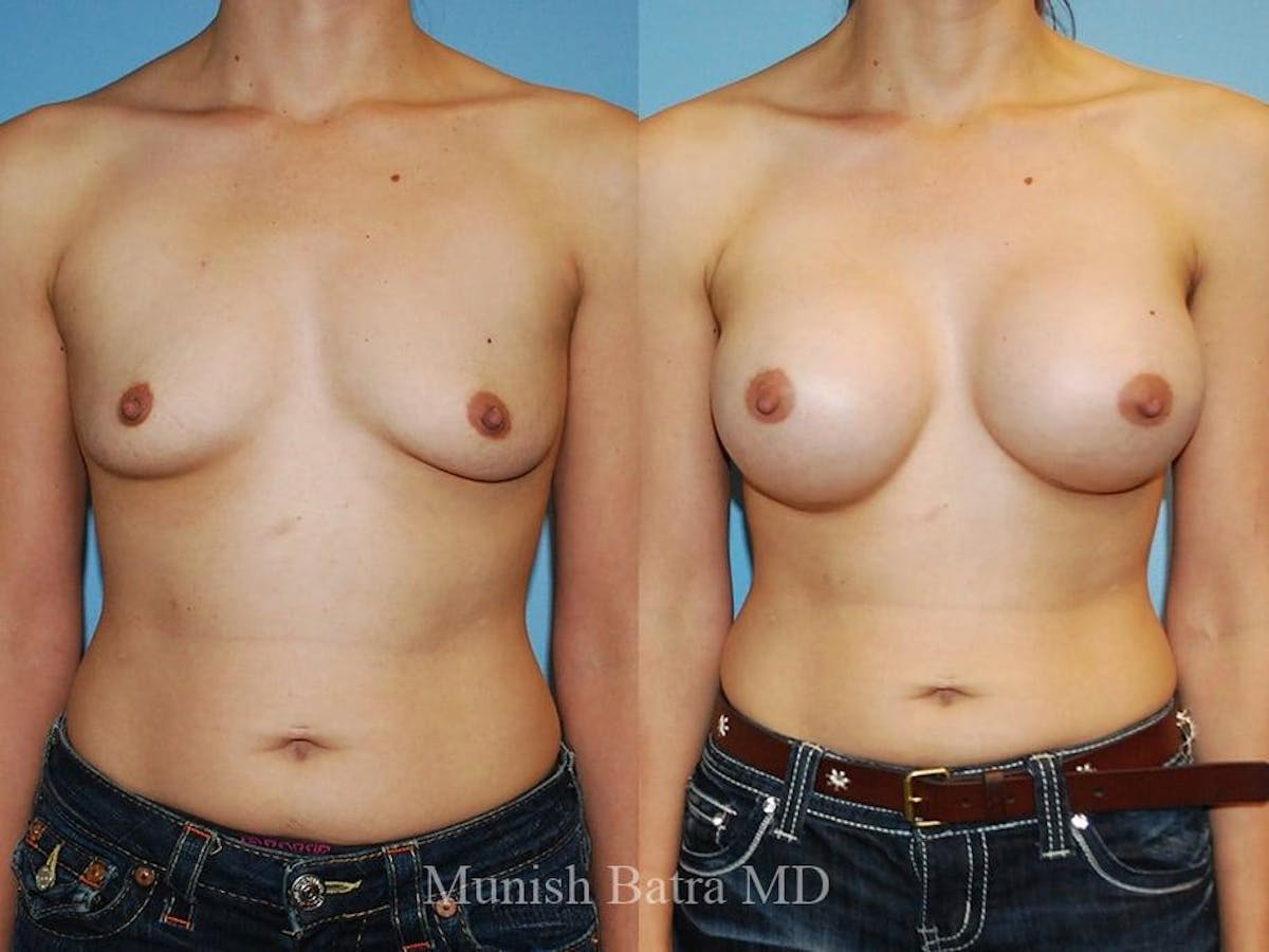 Breast Augmentation Before & After Gallery - Patient 201060 - Image 1