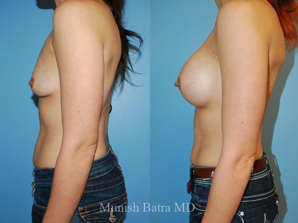 Breast Augmentation Before & After Gallery - Patient 201060 - Image 2