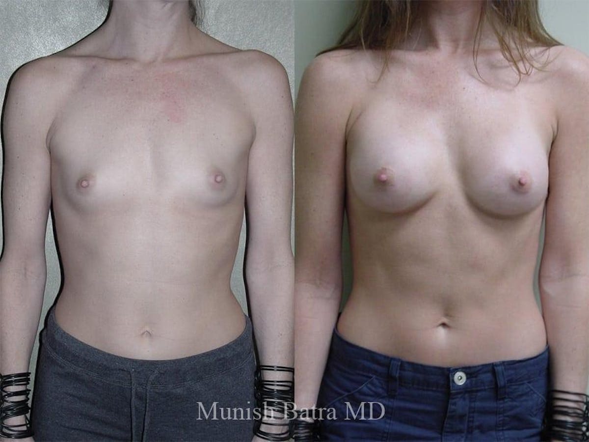 Breast Augmentation Before & After Gallery - Patient 409661 - Image 1