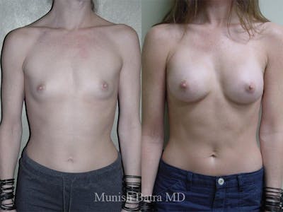 Breast Augmentation Before & After Gallery - Patient 409661 - Image 1