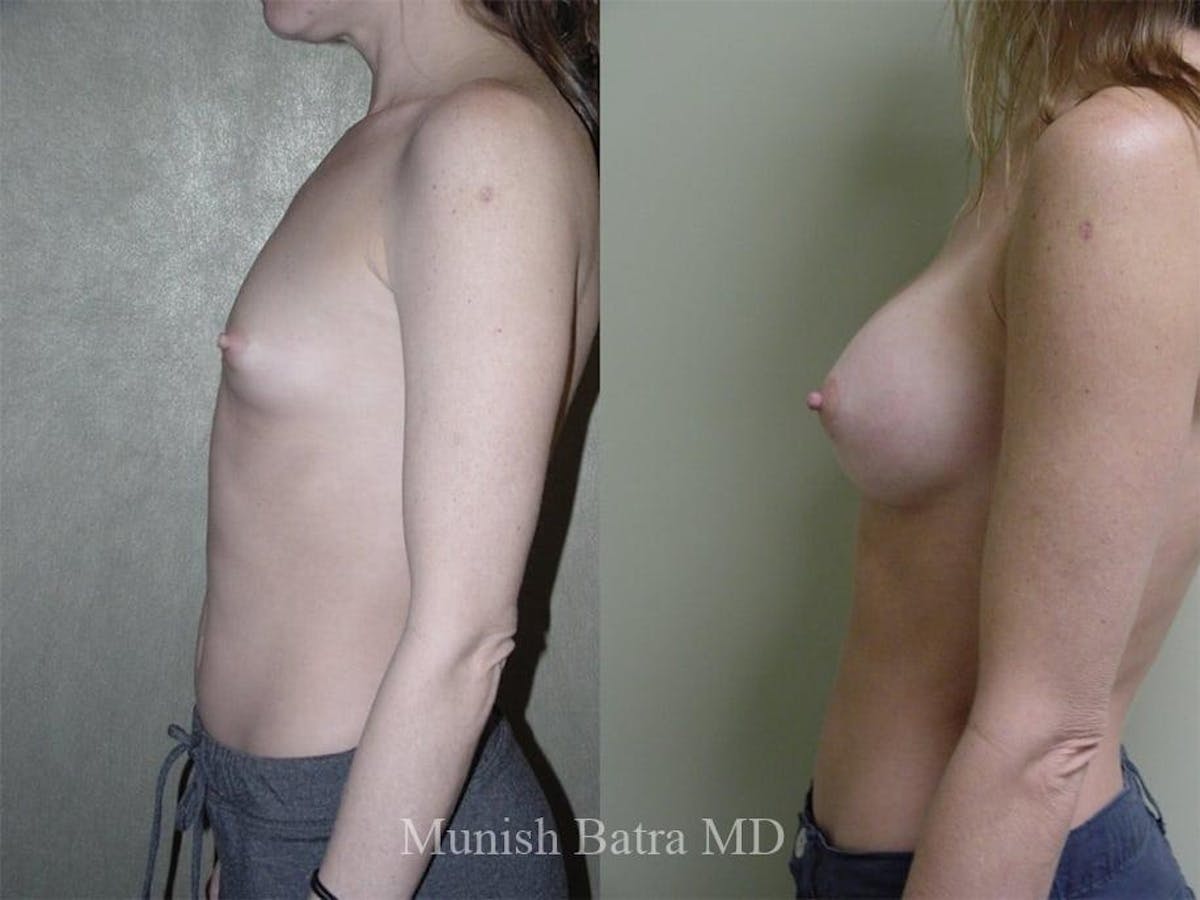 Breast Augmentation Before & After Gallery - Patient 409661 - Image 2