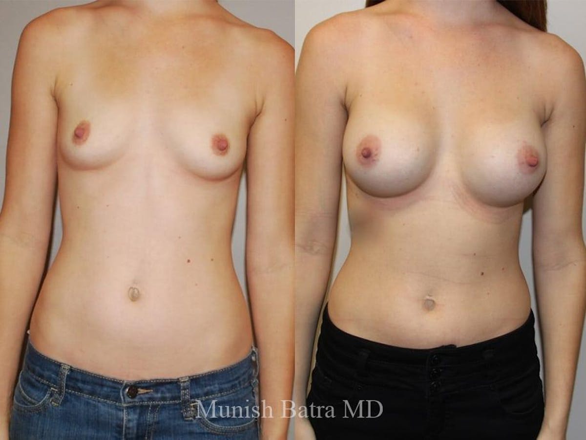 Breast Augmentation Before & After Gallery - Patient 209076 - Image 1