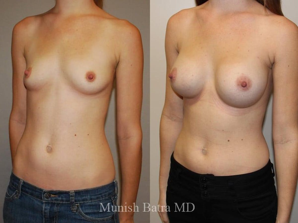 Breast Augmentation Before & After Gallery - Patient 209076 - Image 2