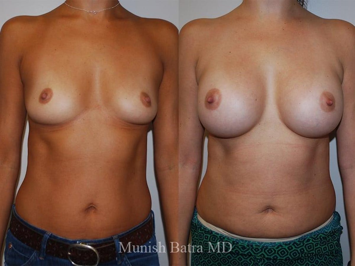 Breast Augmentation Before & After Gallery - Patient 139597 - Image 1