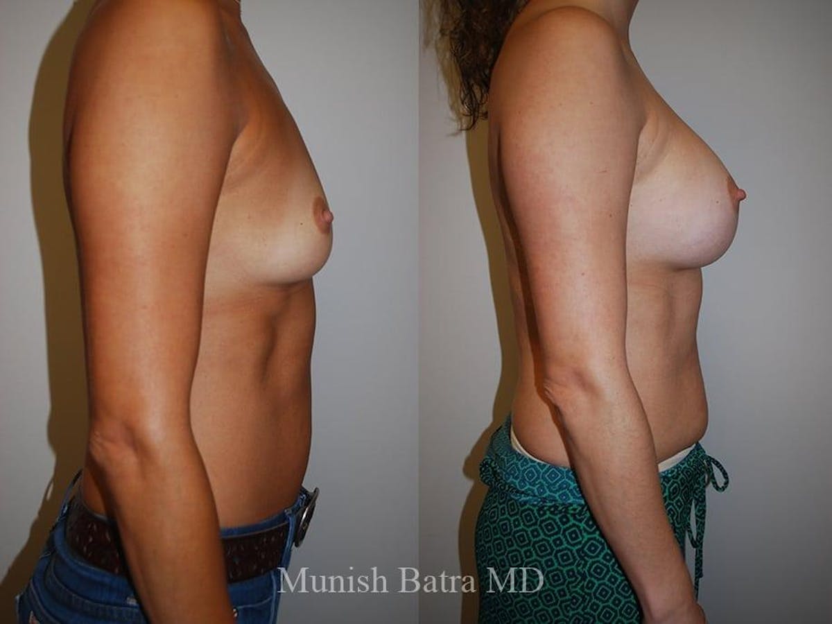 Breast Augmentation Before & After Gallery - Patient 139597 - Image 2