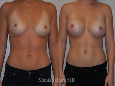 Breast Augmentation Before & After Gallery - Patient 969982 - Image 1