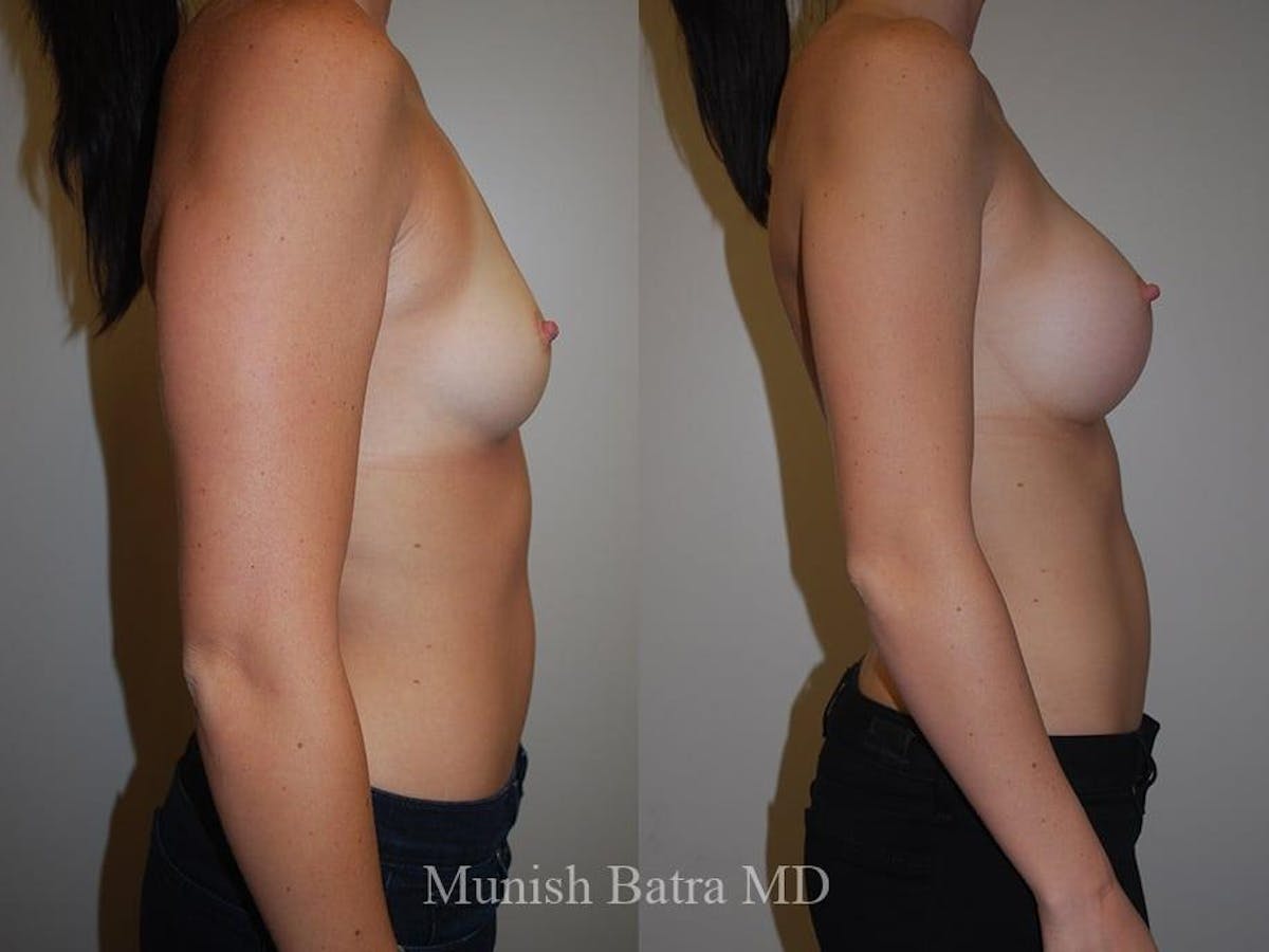 Breast Augmentation Before & After Gallery - Patient 969982 - Image 2