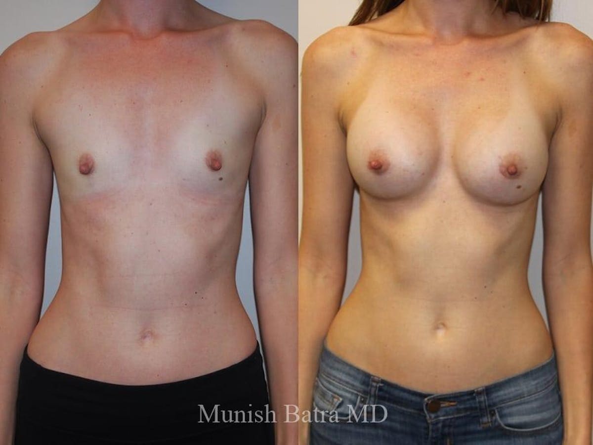 Breast Augmentation Before & After Gallery - Patient 292734 - Image 1