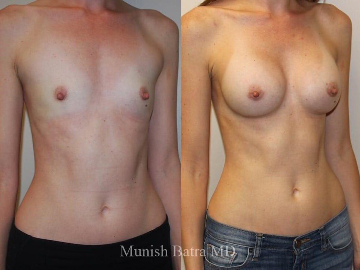 Breast Augmentation Before & After Gallery - Patient 292734 - Image 2