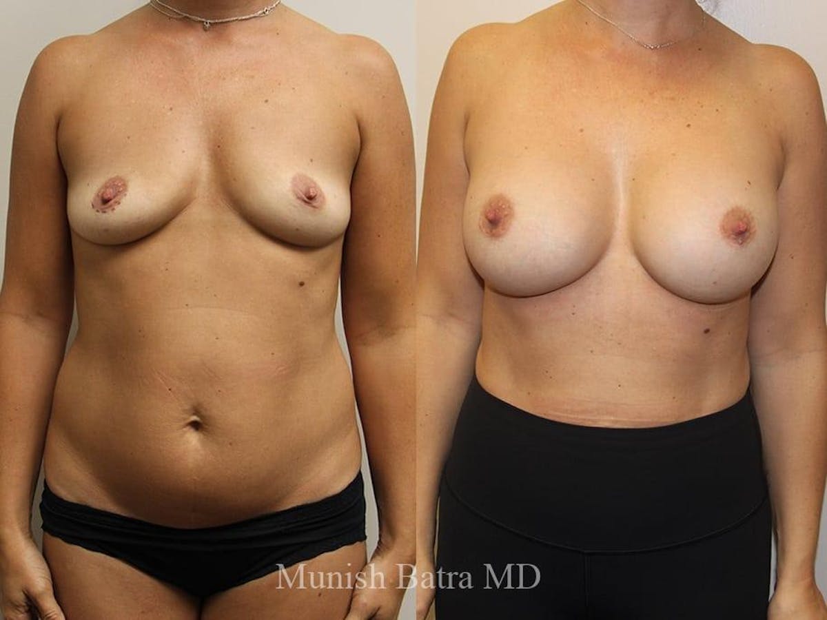 Breast Augmentation Before & After Gallery - Patient 199416 - Image 1