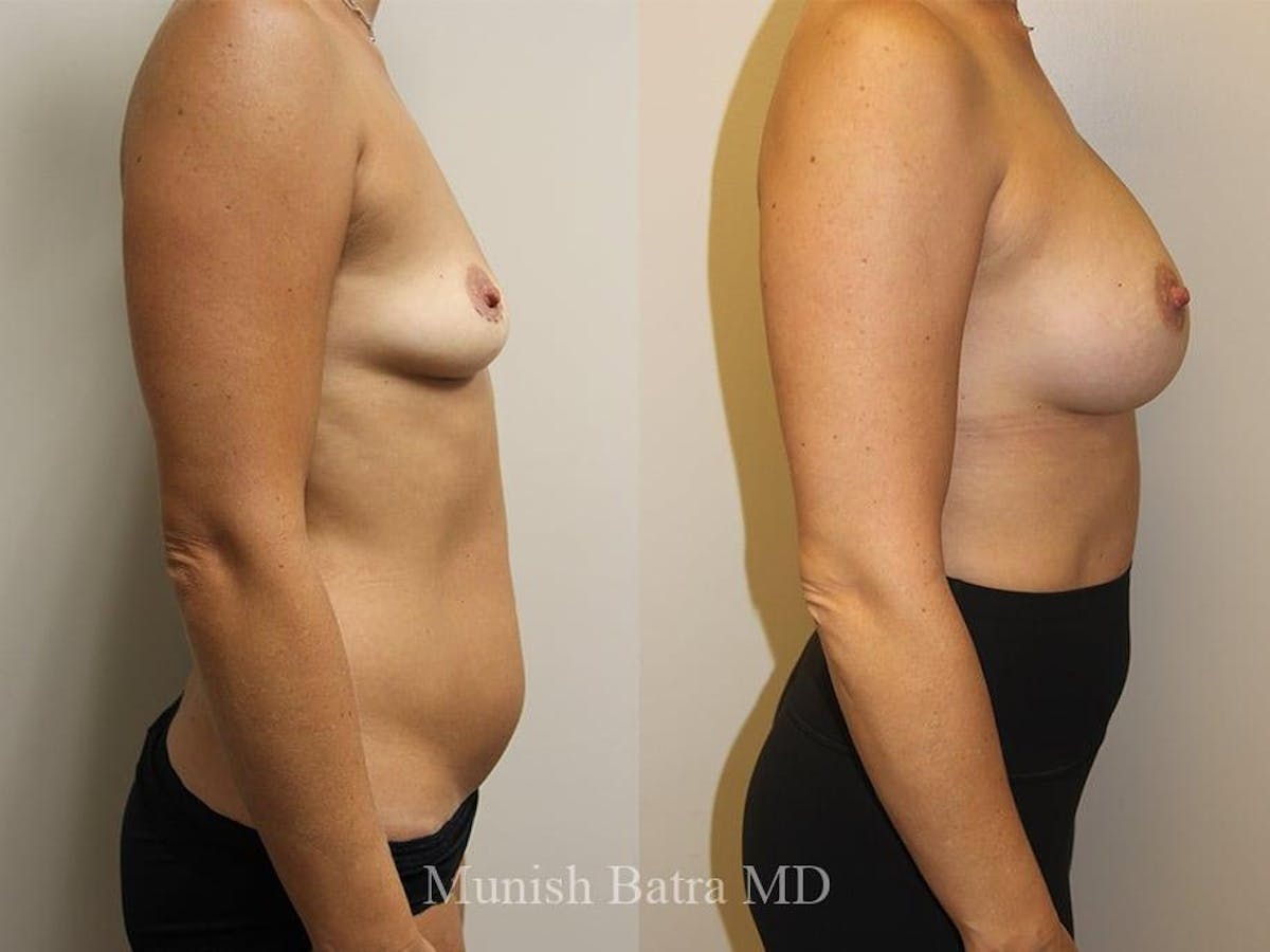Breast Augmentation Before & After Gallery - Patient 199416 - Image 2