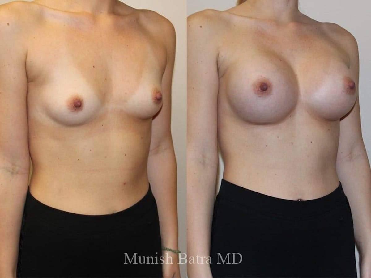 Breast Augmentation Before & After Gallery - Patient 119536 - Image 1