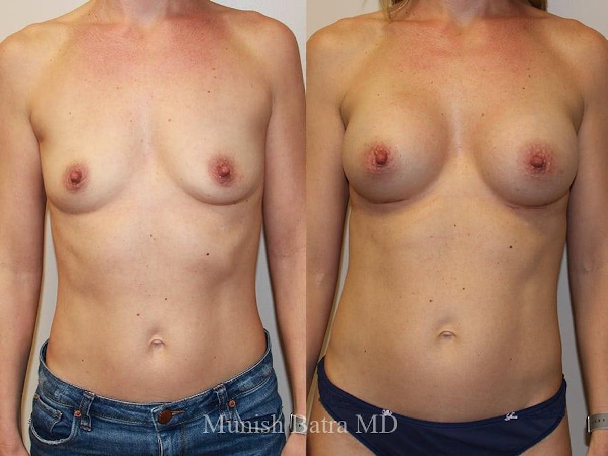 Breast Augmentation Before & After Gallery - Patient 107389 - Image 1