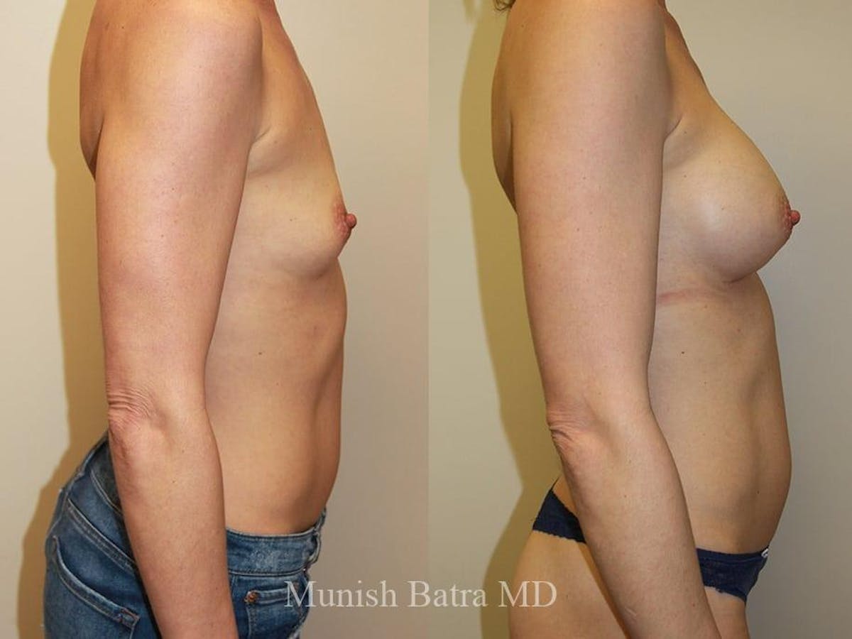 Breast Augmentation Before & After Gallery - Patient 107389 - Image 2