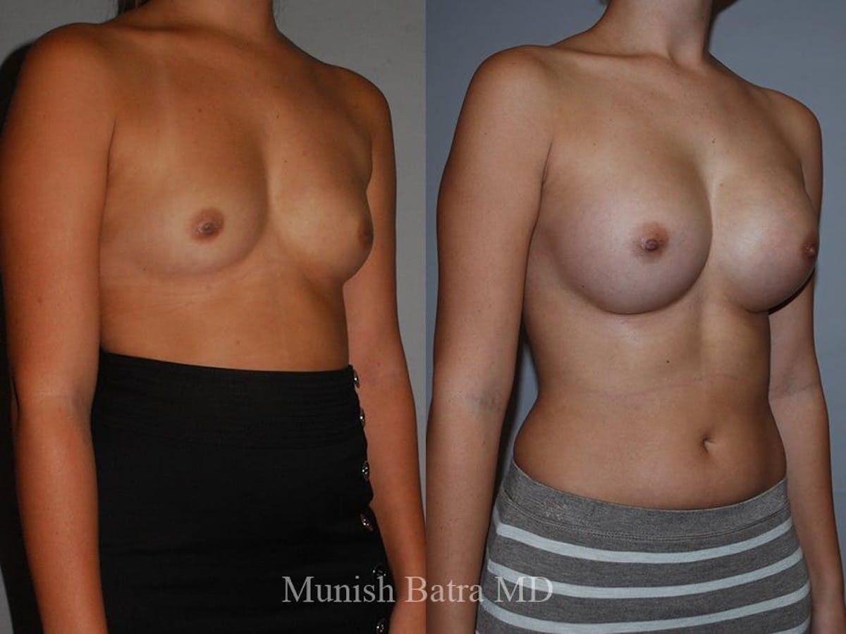 Breast Augmentation Before & After Gallery - Patient 142767 - Image 1